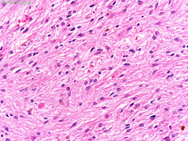 Histology (brightfield) of brain parenchyma stained with Hematoxylin and Eosin (H&E) at approximately 400x magnification reveals classic pilocytic astrocytoma features. The cellular component comprises piloid astrocytes with elongated, slender processes that extend in hair-like cylindrical strands, creating a delicate, feathery background within a variably fibrillary stroma. The biphasic architecture often shows loosely textured, microcystic areas interspersed with more compact, densely packed zones, producing a biphasic appearance. Nuclei are typically bland with modest eccentricity, fine chromatin, and low mitotic activity, supporting a low-grade glioma diagnosis in a pediatric or young adult brain specimen. Rosenthal fibers, thick eosinophilic corkscrew inclusions within processes, may be present but are not universally seen in every field. Background astrocytic processes contribute to a pink, fibrillar matrix, and occasional eosinophilic granular bodies can occur. The observed morphology is highly characteristic of pilocytic astrocytoma and correlates with indolent clinical behavior following maximal safe surgical resection. Clinically, these features distinguish pilocytic astrocytoma from higher-grade astrocytomas and other glial neoplasms. This image is relevant for educational discussion of glial tumors, neuropathology teaching, differential diagnosis, and surgical planning, providing keyword-rich descriptors including piloid cells, hair-like processes, Rosenthal fibers, biphasic pattern, and low-grade glioma. Heightened searchability is achieved through alternative terminology and related terms.