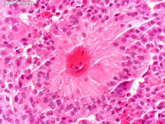 This histopathology image uses hematoxylin and eosin staining to show a central nervous system tumor with classic ependymal differentiation. The tissue exhibits small to medium-sized round to oval nuclei with finely granular chromatin set in a fibrillary, eosinophilic background. A hallmark feature is the arrangement of tumor cells around blood vessels producing perivascular pseudorosettes, with a central zone around the vascular lumen that is relatively nucleus-free. True ependymal rosettes, containing a central lumen lined by tumor cells, are present in a minority of cases (approximately 10%). Overall cellularity is variable, with prominent perivascular organization and occasional ependymal canals. The lesion supports an ependymal lineage; immunohistochemistry would typically show glial fibrillary acidic protein (GFAP) positivity, and EMA often reveals characteristic dot-like perinuclear staining (not evident on H&E). Clinically, classic ependymomas are usually WHO grade II, while the myxopapillary variant is grade I and the anaplastic variant is grade III. The presence of rosettes and pseudorosettes is a defining feature for diagnosis and aids in differentiating from astrocytomas or primitive neuroectodermal tumors. Clinically relevant context includes intraventricular or spinal canal localization, hydrocephalus risk, and prognosis after surgical resection with radiotherapy decisions influenced by location and histologic grade.