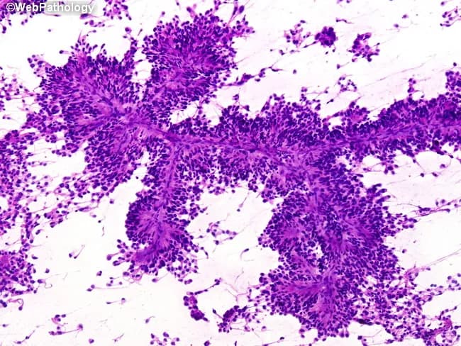 Imaging modality: Cytology smear derived from a central nervous system tumor. Preparation: Hematoxylin and Eosin (H&E) stained smear prepared from a CNS lesion, most consistent with ependymal lineage. The smear shows high cellularity of small, round to oval tumor cells with scant cytoplasm and finely stippled chromatin. The most distinctive feature is perivascular pseudorosette formation: tumor cells arranged in radial cuffs around slender blood vessel cores, creating spoke‑like patterns with intervening delicate fibrillary processes. These cytologic rosettes correspond to the histologic perivascular pseudorosettes seen in ependymoma. The background is fibrillary and slightly basophilic, reflecting glial-type stroma. Nuclei are generally uniform with mild pleomorphism; mitotic activity is limited in this smear. Overall architecture mirrors the histopathology, including ependymal differentiation and possible true rosettes in some fields. Diagnostic significance: The presence of perivascular pseudorosettes strongly supports ependymal differentiation and favors ependymoma, particularly in pediatric or young adult patients. Differential considerations include medulloblastoma with Homer-Wright rosettes and other glial neoplasms; rosette pattern around vessels helps distinguish from true vascular channels. Clinical correlation with imaging findings (ventricular or intraventricular lesion) and patient age enhances diagnostic accuracy and guides management. This description supports educational teaching, cytology-pathology correlation, and differential diagnosis in neuropathology for clinical practice.