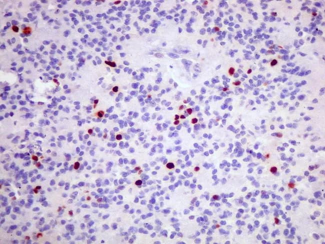 Light microscopy of a formalin-fixed paraffin-embedded brain tumor section stained with Hematoxylin and Eosin (H&E), complemented by Ki-67 immunohistochemistry (MIB-1). The histology demonstrates an ependymal neoplasm with relatively uniform, small round to oval nuclei, scant cytoplasm, and minimal pleomorphism. Architectural features may include perivascular pseudorosettes; true rosettes can be variably evident depending on the field. The tumor shows low to moderate cellularity and rare mitotic figures, consistent with a World Health Organization (WHO) Grade II designation. Ki-67 labeling is low overall, with nuclear positivity up to approximately 5% in some foci and largely negative elsewhere, indicating a relatively indolent proliferative rate. The background is not overtly hyperchromatic, and there is no overt necrosis. Correlation with radiologic imaging and clinical parameters supports a low-grade central nervous system tumor prognosis, though intratumoral heterogeneity may harbor focal proliferative hotspots. This image is valuable for pathology education, neural tumor grading, and multidisciplinary case discussions, including neurosurgery, neuropathology, and neuro-oncology teams. Keywords: ependymoma, CNS tumor, brain tumor, WHO Grade II, Ki-67, MIB-1, proliferation index, perivascular pseudorosette, histology, H&E, duplicate staining, FFPE, brain pathology, neuropathology education. This descriptive caption supports targeted search terms for education, diagnosis, prognosis assessment, and research on CNS ependymal tumors and outcomes.