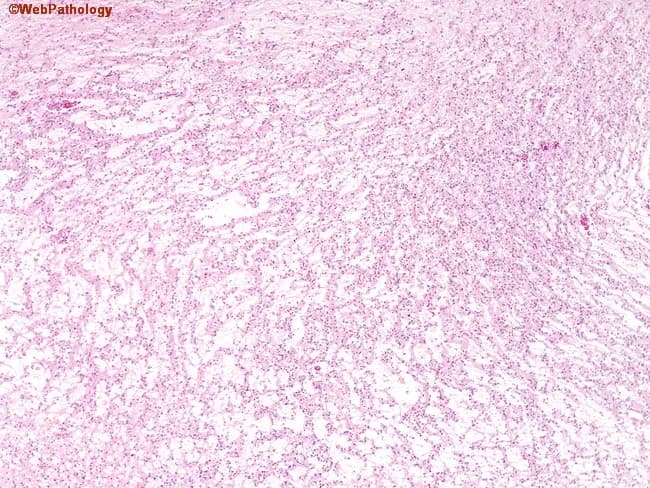 Wide-field histopathology of a neural tumor showing gelatinous nodules composed of ribbons of oligodendroglioma-like cells, often arranged around vasculature. Inter-nodular areas display mucin-rich pools in which scattered normal and dysmorphic ganglion cells are seen, described as floating neurons among the neoplastic glial population. The oligodendroglia-like cells exhibit uniform, round nuclei with perinuclear clearing (fried-egg appearance) set in a myxoid to mucinous background. Blood vessels may be surrounded by tumor cells, underscoring a perivascular growth pattern. The overall architecture is nodular and gelatinous, with alternating densely cellular glial nodules and less cellular mucinous zones. These features suggest a glioneuronal tumor with oligodendroglial differentiation and neuronal components; differential diagnoses include oligodendroglioma with neuronal differentiation or a mixed glial-neuronal tumor such as oligodendroglioma/ganglioglioma spectrum, or oligoastrocytoma depending on molecular context. The presence of mucin pools and floating ganglion cells is characteristic of ganglioglioma-like maturation. Molecular correlates (not shown) such as IDH mutation and 1p/19q co-deletion would support oligodendroglioma, whereas absence could favor ganglioglioma or other dysembryoplastic lesions. Clinically relevant for prognosis and treatment planning, as 1p/19q status informs chemo-sensitivity and survival. This histology would be essential for neuropathology conference discussion and guiding surgical and adjuvant therapy decisions.