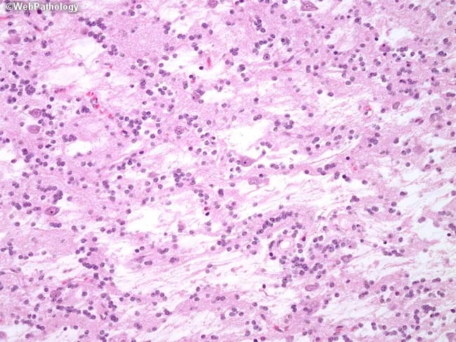 Comprehensive Description: This histopathology slide depicts a glial tumor of the brain with oligodendroglioma-like morphology. The intranodular or inter-nodular areas are composed of small, round to oval cells with relatively dispersed chromatin and prominent perinuclear halos giving a fried-egg appearance. The tumor cells are arranged in sheets and subtle neuropil-like stroma; capillary networks may be present but conspicuous mitotic activity and necrosis are not observed. In a subset of cases, foci resembling pilocytic astrocytoma or ganglioglioma with astrocytic processes or neuronal components can be identified, though these features are not universally present. Endothelial hyperplasia and necrosis are typically absent, supporting a low to intermediate grade phenotype. The pattern suggests a glial neoplasm with oligodendroglial differentiation; the presence of calcifications is not clearly evident in this field but would have diagnostic significance if seen. Clinically, these findings warrant correlation with neuroimaging to assess tumor location and frontal or temporal lobe involvement, calcifications, and cortical invasion. Immunohistochemistry and molecular studies (e.g., IDH mutation status, 1p/19q co-deletion) would provide definitive classification and prognostic information, distinguishing oligodendroglioma from pilocytic astrocytoma or ganglioglioma. This image is relevant for educational teaching, differential diagnosis, and research into glial-neuronal tumors.