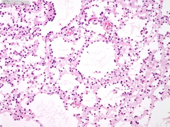 This histopathology image depicts a brain tissue biopsy stained with Hematoxylin and Eosin, viewed under light microscopy. The section shows diffuse infiltration by small, round to ovoid oligodendroglia-like cells with perinuclear halos and delicate capillary networks—classic fried-egg cytology with a chicken-wire vascular pattern. The tumor preferentially involves white matter and shows cortical invasion with perineuronal satellitosis, features that favor oligodendroglioma over other glial neoplasms in small samples. In this image, cellularity is moderate and nuclei are uniform with fine chromatin; the background is extracellular pink stroma. DNT (dysembryoplastic neuroepithelial tumor) is in the differential, particularly in young patients, but DNT often exhibits a distinctive columnar and meningioid component with specific architectural patterns not conspicuously evident here. The diagnostic significance lies in recognizing oligodendroglioma morphology and guiding ancillary testing, including molecular studies for IDH mutation and 1p/19q codeletion, which refine diagnosis and prognosis. Clinical implications include surgical resection planning, adjuvant radiotherapy, and alkylating chemotherapy considerations. Potential differential diagnoses include astrocytoma, ganglioglioma, and glioblastoma for lesions with higher-grade features. This image is valuable for pathology education, tumor classification discussions, and histology-based differential diagnosis in neuro-oncology. This contextualizes pathology findings for clinical decision-making and supports education in neuro-oncology curricula and research across disciplines.