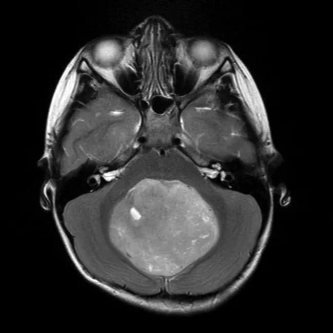 Magnetic Resonance Imaging (MRI) of the brain in axial orientation demonstrates a large midline posterior fossa mass arising from the cerebellar vermis in a 6-year-old. The lesion is hyperintense on T2-weighted imaging and exhibits only patchy enhancement after gadolinium administration, indicating a predominantly solid tumor with heterogeneous vascularity. The mass completely effaces the fourth ventricle and obscures the normal vermis, causing crowding of surrounding cerebellar tissue and potential obstructive hydrocephalus. Radiographic features are highly suggestive of a medulloblastoma in a pediatric patient, with typical midline vermian origin and posterior fossa dominance. The diagnosis was confirmed histologically by biopsy. Differential considerations include pilocytic astrocytoma, ependymoma, atypical teratoid/rhabdoid tumor (ATRT), and other cerebellar neoplasms, but patient age and vermian involvement favor medulloblastoma. Clinically, this lesion warrants neurosurgical resection followed by adjuvant therapy (radiation and chemotherapy) per pediatric brain tumor protocols. The image is consistent with radiology-pathology correlation and supports treatment planning, prognostication, and educational use. This case illustrates classic pediatric posterior fossa tumor morphology, diffusion characteristics not shown here, and the importance of post-contrast imaging in defining tumor extent and fourth ventricle involvement. This information enhances indexing for neuro-oncology research and case-based medical education. It aids radiologists and clinicians in recognizing this tumor in young children.