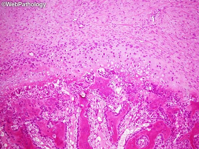 Subungual exostosis histology showing an osteochondral proliferation arising from the distal phalanx and extending beneath the nail bed. The specimen is an excisional/biopsy material stained with Hematoxylin and Eosin (H&E). Low-power examination reveals a zoned architecture with superficial fibrous and fibroblastic stroma merging into cartilaginous metaplasia, consistent with a developing cartilaginous cap. Deeper in the specimen, irregular woven bone trabeculae form by endochondral ossification and are rimmed by plump osteoblasts. The intertrabecular spaces are filled with vascular connective tissue, reflecting active remodeling. In early maturation zones, proliferating cellular fibroblasts blend with cartilaginous tissue; as maturation proceeds, the cartilaginous cap thickens and couples with osseous formation to yield an osteochondral core. Mitotic activity may be relatively high in proliferative regions, yet there are no atypical mitoses or cytologic atypia. The lesion thus demonstrates both fibrocartilaginous callus features and an osteochondroma-like cartilaginous cap with a bony stalk. Clinically, these histologic features support a benign, self-limited exostosis of the distal phalanx, typically presenting under the nail with nail deformity or tenderness. Distinction from malignant periungual tumors relies on preserved architecture, absence of invasion, and lack of cytologic atypia.