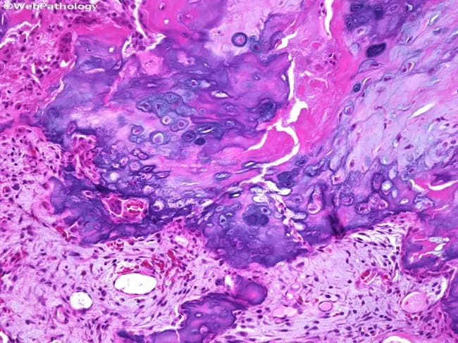 Imaging modality: Light microscopy of a hematoxylin and eosin (H&E) stained histopathology section derived from a periosteal bone lesion. Primary subject: bizarre parosteal osteochondromatous proliferation (BPOP) with irregular endochondral ossification and a cartilaginous/bony matrix on the periosteal surface. Anatomical location: periosteum of cortical bone; commonly involved long bones and especially digits; tissue consists of osteochondral components with cartilage cap and bone trabeculae. Visual features include disorganized cartilage islands, irregular ossification patterns, and a conspicuous blue tinctorial matrix on H&E, reflecting mucopolysaccharide-rich cartilage matrix; chondrocyte clusters with mild atypia may be present; interface with fibrous periosteum demonstrates a non-destructive, non-infiltrative growth. Pathology reveals disorganized osteochondral proliferation rather than malignant invasion. Diagnostic significance centers on recognizing BPOP histology to distinguish from osteochondroma and parosteal osteosarcoma; irregular ossification and blue-cartilage matrix are characteristic clues. Potential clinical use cases encompass diagnostic pathology consultations, educational histology resources, and research comparisons of periosteal osteochondral lesions; this pattern informs surgical planning, prognosis, and follow-up for recurrence risk.