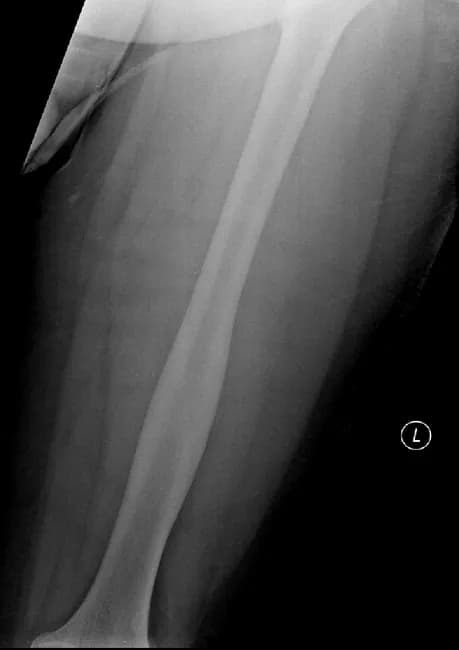 This is a musculoskeletalPlain radiograph (AP view) of the left femur showing cortical thickening and sclerosis within the mid-to-distal femoral cortex. Radiographs alone do not reveal a discrete nidus, which is common for osteoid osteoma on X-ray. The accompanying CT (not shown in this image) demonstrates a small radiolucent nidus within the thickened cortex, with no periosteal reaction or soft-tissue mass, and no aggressive features. The radiographic pattern of focal cortical sclerosis with a nidus on CT is classic for cortical osteoid osteoma, a benign osteogenic tumor that typically presents with localized nighttime pain relieved by NSAIDs in young to middle-aged adults. Differential considerations include osteoblastoma (larger nidus, possible aggression), stress fracture (cortical lucency with sclerosis), and Brodie abscess (infectious nidus-like lesion). Clinically, correlation with pain characteristics and CT nidus confirmation enhances diagnostic accuracy and guides therapy. This image is valuable for radiology education, differential diagnosis practice, and pre-interventional planning (nidus ablation or surgical excision), illustrating imaging-histology correlation and the importance of CT in identifying the nidus when radiographs are inconclusive.