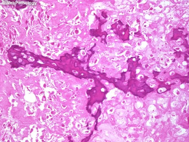 This is a post-treatment osteosarcoma histology slide derived from a limb-sparing surgical resection after neoadjuvant chemotherapy. The imaging modality is bright-field light microscopy of Hematoxylin and Eosin (H&E) stained bone tumor tissue. The specimen demonstrates marked sclerosis with densely packed bony trabeculae and extensive tumor necrosis. In many fields there is cell dropout and a paucity or absence of viable neoplastic cells, reflecting a favorable chemotherapeutic response. Interspersed foci show coagulative necrosis with residual granulation tissue replacing tumor; occasional residual osteoid production may be present. Areas of cartilage formation are evident consistent with chondroblastic osteosarcoma components, which are often relatively chemo-resistant. Overall the lesion displays reduced cellularity, abundant necrosis, and prominent post-treatment remodeling within the metaphyseal bone environment. The diagnostic significance lies in evaluating the degree of tumor response to neoadjuvant chemotherapy, which remains prognostically important but lacks universally accepted, standardized necrosis quantification guidelines. Clinically, these histologic changes inform prognosis, surgical margins assessment, and decisions regarding adjuvant therapy. Potential differential considerations include distinguishing post-therapy necrosis and granulation tissue from residual viable tumor and recognizing heterogeneity of response within tumor foci. Correlation with preoperative imaging and clinical course is essential for accurate interpretation.