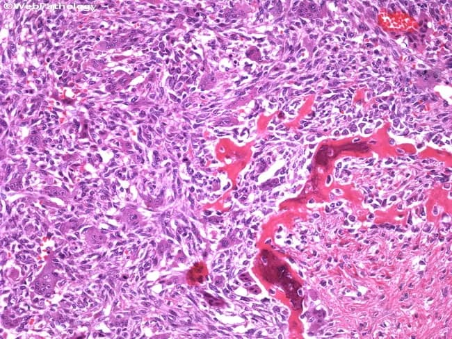 Histopathology of a giant cell tumor of bone. This light-m microscopy image uses Hematoxylin and Eosin staining to reveal the characteristic architecture of a GCT rather than an osteoid-producing sarcoma. The tissue section demonstrates a cellular stroma composed of mononuclear ovoid to spindle-shaped cells with evenly distributed, numerous osteoclast-like multinucleated giant cells. The giant cells display uniformly stained cores with multiple nuclei per cell, set within a vascular, often hemorrhagic background. The mononuclear component tends to be relatively bland, with minimal nuclear atypia and occasional mitotic activity, supporting a benign but locally aggressive neoplasm. Reactive bone formation can be present at the periphery in rare cases, potentially confounding the diagnosis by suggesting osteosarcoma; however, malignant osteoid is typically absent or scant, and the overall pattern is a mosaic of giant cells interspersed with mononuclear stromal cells rather than malignant osteoid production. Clinically, this histology correlates with an epiphyseal/metaphyseal bone lesion in adults, presenting with pain and swelling. The diagnostic significance lies in distinguishing GCT from osteosarcoma and other giant cell-rich lesions, guiding surgical management such as intralesional curettage with adjuvant therapy or resection, and informing prognosis given the risk of local recurrence. Correlation with imaging and clinical data improves accuracy.