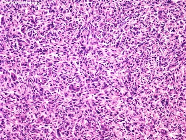 Histopathology of giant cell tumor of bone demonstrated on Hematoxylin and Eosin stained sections, visualized by bright-field light microscopy. The specimen represents a skeletally derived tumor bed with abundant spindle-shaped stromal cells interspersed with numerous multinucleated giant cells resembling osteoclasts. The mononuclear cells are typically evenly distributed, with minimal cytologic atypia and rare mitotic activity, providing a cellular yet non-atypical background. The giant cells are conspicuous but evenly dispersed, with numerous nuclei per cell in a peripherally oriented pattern. The matrix is typically collagenous with a vascular stroma, and hemorrhagic or foamy macrophages may be present. In this illustrative image, sheets of spindle cells exhibit mild pleomorphism but lack overt nuclear atypia, supporting a benign/low-grade neoplasm rather than high-grade sarcoma. Diagnostic significance lies in recognizing the characteristic osteoclast-like giant cells coexisting with a uniform mononuclear stromal component. Knowledge of this histology helps differentiate GCT from other sarcomas, guides management (curettage versus en bloc resection), and correlates with radiographic epiphyseal lesions in long bones. Additional differential considerations include fibrosarcoma and other spindle-cell sarcomas, but the uniform stromal population with evenly distributed osteoclast-like giant cells and absence of nuclear atypia aids accurate classification. This histologic profile informs surgical planning, biopsy interpretation, adjuvant decisions, and radiologic correlation in long-bone epiphyseal lesions.