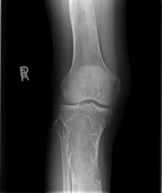 AP knee radiograph demonstrates features of polyostotic fibrous dysplasia in the distal femur and proximal tibia with characteristic ground-glass osteopathy. The lesions show diffuse sclerosis with soap-bubble trabeculation, endosteal scalloping, cortical thinning, and mild to moderate osseous expansion. The epiphyses are spared, and there is no periosteal reaction. These radiographic traits—intralesional lucencies and heterogeneous sclerosis within the medullary cavity—reflect abnormal fibrous tissue replacing normal cancellous bone. The imaging pattern matches Mazabraud syndrome when coupled with MRI-detected intramuscular myxomas in the vastus medialis near affected bones, pointing to a polyostotic FD with soft-tissue tumors. The diagnostic significance lies in distinguishing fibrous dysplasia from malignant bone processes and guiding management toward conservative bone-targeted therapies and orthopedic monitoring. Differential diagnoses include benign fibrous lesions and less likely entities such as osteosarcoma or Langerhans cell histiocytosis. Clinically, these findings explain hip and knee pain; radiographs serve as baseline for surveillance and MRI correlation for soft-tissue lesions. This case reiterates the Mazabraud spectrum: fibrous dysplasia with intramuscular myxomas, requiring multidisciplinary radiologic-pathologic correlation and longitudinal follow-up. Recognition of this pattern supports targeted MRI assessment of soft tissues and guides surveillance imaging intervals, biopsy decisions, and multidisciplinary planning for orthopedic oncology and radiology teams.