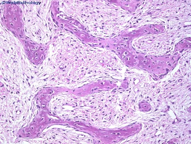 Histology of fibrous dysplasia showing a fibroblastic stroma with irregular immature woven bone trabeculae. The bony trabeculae are narrow, curvilinear or irregularly shaped and arranged haphazardly within a dense fibrous matrix. Trabeculae are immature and inadequately mineralized, lacking osteoblastic rimming, reflecting a maturation defect with failure to form lamellar bone. Reversal lines may be present within the woven bone, a feature that can resemble Paget’s disease in some fields but without the extensive osteolysis or mosaic lamellar pattern. A chondroid component is seen in about 10% of cases, sometimes strikingly prominent, contributing to a mixed fibrous–chondroid pattern. Areas of cystic change can occur, containing lipid-laden macrophages and occasional multinucleated giant cells. Overall, the lesion demonstrates fibrous tissue interlacing with irregular osseous trabeculae, with relatively bland fibroblast populations and no significant cytologic atypia. These histologic features indicate a benign, developmental bone lesion driven by abnormal osteogenesis and fibroplasia. Clinically, the pattern may range from monostotic to polyostotic disease, often presenting in childhood or adolescence with painless swelling or deformity. The diagnostic significance lies in recognizing the maturation defect of bone and distinguishing it from other fibro-osseous lesions. Correlation with radiographs and clinical findings is essential for accurate diagnosis and management planning.