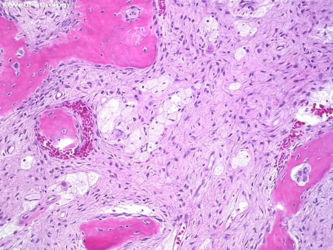 This histopathology image depicts a bone lesion analyzed by light microscopy after formalin fixation and hematoxylin and eosin staining. The cortical and trabecular bone shows irregular, curvilinear woven bone spicules embedded in a dense, moderately cellular fibroblastic stroma. The bony trabeculae lack osteoblastic rimming, a hallmark feature distinguishing fibrous dysplasia from normal lamellar bone and from reactive osseous processes. The surrounding stroma contains spindle-shaped fibroblasts with bland nuclei, and within the intertrabecular spaces there are clusters of lipid-laden macrophages (foam cells) and admixed adipocytes, consistent with marrow replacement by fibrous tissue with fatty elements. The overall pattern may resemble a Chinese-letter configuration in some fields but is variable; there is no significant atypia or mitotic activity. These features collectively support a benign fibro-osseous lesion with fibrous stroma and irregular woven bone, rather than a malignant sarcoma. Clinically, this histology is compatible with fibrous dysplasia of bone, often associated with adolescence or young adulthood and presenting as painless swelling or deformity; radiographs commonly show a ground-glass appearance with preserved/expanded cortex. Diagnostic significance lies in recognizing the combination of immature woven bone in fibrous stroma with absent osteoblastic rimming, which differentiates fibrous dysplasia from ossifying fibroma and low-grade osteosarcoma. Potential use includes guiding surgical planning, confirming fibro-osseous pathology, and correlation for diagnosis.