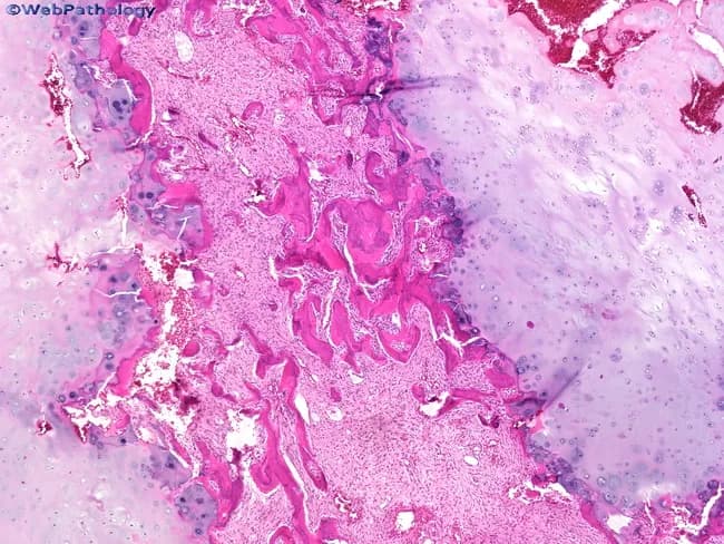 Histology of fibrous dysplasia. This hematoxylin and eosin stained bone biopsy section reveals a fibroblastic stroma populated by spindle-shaped cells and irregular, immature woven bone trabeculae. The trabeculae are variably sized, often curved or irregular in shape, resembling a Chinese character pattern, and they lack a consistent osteoblastic rim. The surrounding stroma is fibrous and moderately cellular, with a bland appearance and sparse mitotic activity. In this case, nodules of hyaline cartilage are present on either side of the osseous component, illustrating chondroid differentiation within the lesion. The chondroid component can be strikingly prominent in some fibrous dysplasia cases, contributing to a mixed fibro-osseous phenotype. Overall, the combination of woven bone within fibrous stroma and cartilaginous nodules supports a benign fibrous-osseous process rather than a malignant tumor; however, the cartilaginous elements may raise differential considerations such as chondromatous differentiation or low-grade chondrosarcoma if atypia were evident. Clinically, these features correspond to a slow-growing, benign lesion of bone that may cause deformity or structural weakness depending on location. This histologic pattern is classic for fibrous dysplasia and highlights heterogeneity within the lesion, including possible cartilage-rich variants and variable radiographic correlation. These features aid surgical planning and prognosis.