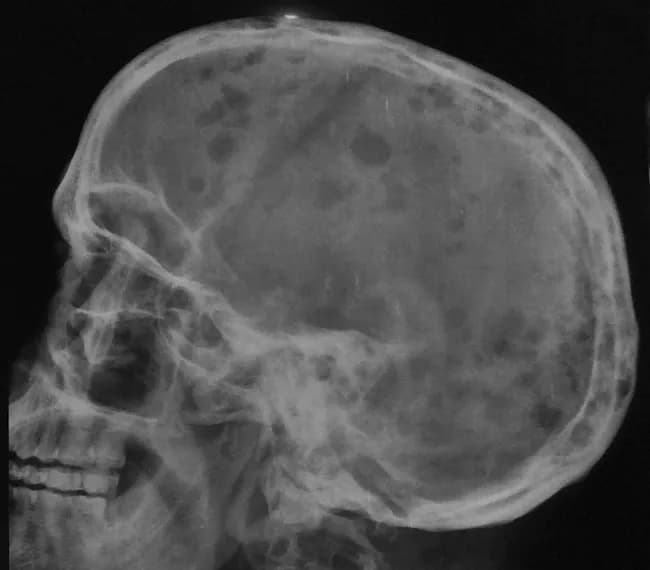 Imaging modality: Skull radiography using a lateral skull view. In a 50-year-old male with weakness, fatigue, backache, weight loss, anemia, and positive Bence Jones protein, the skull radiograph shows multiple small, uniform, sharply demarcated punched-out lytic lesions without sclerotic margins. There is involvement of the calvarial bones with osteolytic foci and mandibular lesions; generalized osteopenia is evident with diffuse reduction in bone density. No periosteal reaction or reactive sclerosis is observed. The lesions originate in the medullary cavity, progressively destroying cancellous bone and eroding toward the cortex, thus increasing the risk of pathologic fracture. This radiologic pattern is highly suggestive of a disseminated plasma cell neoplasm, most consistent with plasma cell myeloma. The imaging findings correlate with systemic disease and can be used for initial assessment and staging, as well as monitoring response to therapy. Radiology findings prompt complementary laboratory and biopsy investigations (serum/urine electrophoresis, bone marrow biopsy) to confirm monoclonal plasma cell proliferation. Clinically, skull involvement contributes to bone pain and skeletal-related events; imaging guides treatment planning, assesses therapeutic response, and monitors disease progression over time. In the context of the described case, the radiographic appearance aligns with classic myeloma hallmarks in the skull and mandible. Case verified clinically.