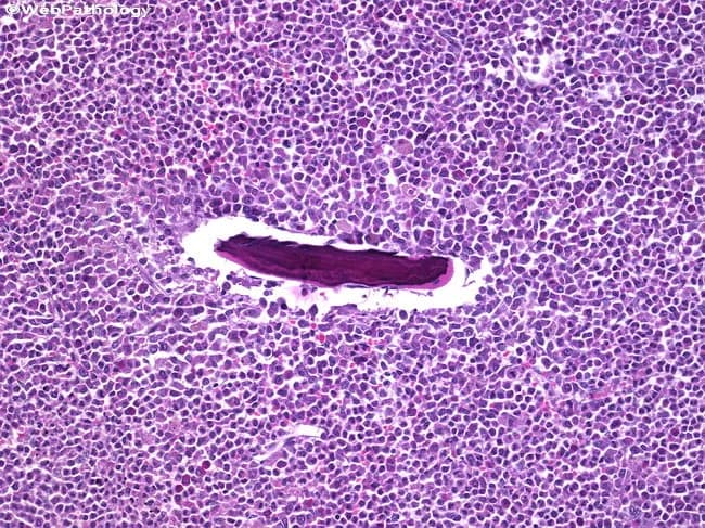 Imaging modality: Histopathology with brightfield microscopy of an H&E stained femoral bone lesion. The specimen shows a dense, cellular marrow‑like infiltrate occupying bone with disruption of normal trabecular architecture. Individual cells are small to medium in size with high nuclear‑to‑cytoplasmic ratio, finely dispersed chromatin, and prominent nucleoli, compatible with myeloblasts. The cell population forms diffuse sheets with scant cytoplasm and frequent mitotic figures. Invasion surrounds a central vascular channel, and occasional residual bone spicules may be seen, consistent with granulocytic sarcoma (myeloid sarcoma), an extramedullary manifestation of acute myeloid leukemia. In the clinical context of chronic myeloid leukemia in blast crisis, this lesion reflects leukemic infiltration of periosteal and marrow compartments, often signaling systemic progression. When integrated with immunophenotype and molecular studies, this tissue supports diagnosis within the AML/acute leukemia spectrum and guides therapy toward AML‑type chemotherapy and consideration of stem cell transplantation. The image is relevant to differential diagnoses such as lymphoma, Ewing sarcoma, and other small round blue cell tumors, especially when cytochemical stains are unavailable. This histopathologic finding emphasizes the importance of evaluating myeloid neoplasms for extramedullary disease in bone and its implications for prognosis, staging, and multidisciplinary management.