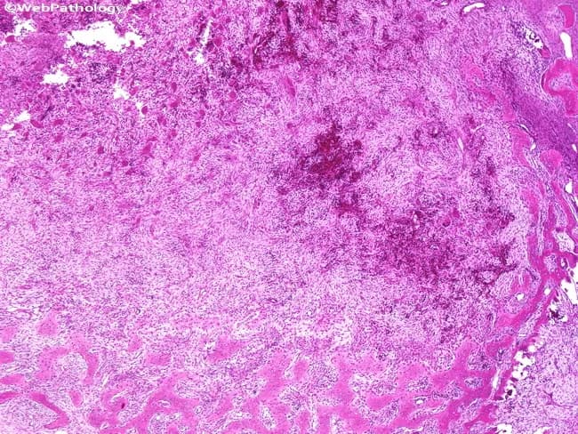 This histopathology image depicts an osteitis fibrosa cystica (brown tumor) within bone in the setting of hyperparathyroidism. The center shows a zone of bone resorption with loss of normal trabecular architecture, replaced by a fibrous, cellular stroma. The lesion is filled with fibrous tissue containing spindle-shaped fibroblasts and occasional osteoclast-type giant cells and hemorrhagic debris; the periphery demonstrates osteoid production forming an immature woven bone matrix with a fibrous dysplasia-like appearance. The overall pattern includes a mixture of radiating fibrous tissue and newly formed osteoid at the margins, which mimics fibrous dysplasia. The histologic spectrum reflects exuberant bone remodeling driven by excess parathyroid hormone, with interspersed areas of osteoclast resorption and fibrous tissue that may produce cystic spaces. Clinically, such brown tumors are part of osteitis fibrosa cystica and signal advanced hyperparathyroidism; identification on biopsy prompts evaluation of parathyroid function and calcium-phosphate homeostasis. Differential considerations include fibrous dysplasia, giant cell-rich lesions, and osseous metastases; however, the association with systemic hyperparathyroidism and parathyroid dysfunction supports the diagnosis. This image is relevant for medical students, pathology residents, and clinicians assessing metabolic bone disease, surgical planning, and educational case reviews.