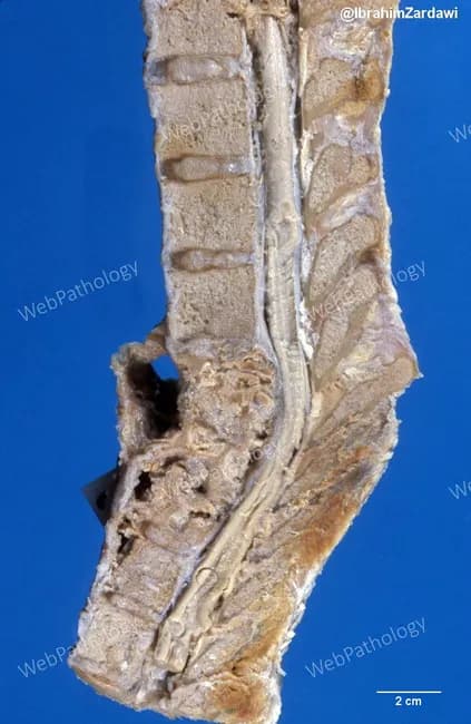Comprehensive Description: Gross pathology photograph of the lumbar spine showing advanced tuberculous spondylitis (Pott disease). Modality and technique: macroscopic photograph of a sagittal spinal section derived from a lower thoracic–lumbar segment; scale bar included (2 cm). Anatomical context: involves three contiguous lumbar vertebrae with adjacent intervertebral discs, consistent with TB‑related destruction (likely L1–L3). Imaging perspective: sagittal view emphasizing anterior column collapse and disc-space involvement. Visual features: extensive vertebral body destruction with irregular, porous cancellous bone; anterior vertebral column collapse; irregular endplates; disc-space narrowing; preserved posterior elements to varying degrees; surrounding soft-tissue reaction and potential paravertebral changes visible along the spinal canal. Diagnostic interpretation: gross correlate of tuberculous osteomyelitis with granulomatous inflammation; pattern of contiguous vertebral involvement and disc destruction supports tuberculous etiology over pyogenic infection or metastasis. Clinical relevance: highlights risk of spinal canal compromise and paraplegia in Pott disease; informs surgical planning for decompression and stabilization and reinforces need for systemic anti‑tuberculous therapy. Differential considerations: pyogenic spondylitis, brucellar spondylitis, spinal metastasis, fungal vertebral osteomyelitis; clinical correlation and microbiology needed. Educational use: suitable for medical students, residents, and pathology education focusing on spinal tuberculosis gross pathology features. Correlative imaging findings on MRI or CT may reveal vertebral collapse and prevertebral abscess; this specimen-based description complements clinical TB workup.