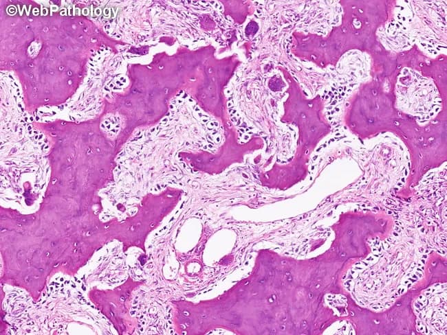 This is a histopathology image of Paget disease of bone (osteitis deformans) in the mixed osteolytic-osteoblastic phase, assessed on a bone biopsy by bright-field light microscopy after Hematoxylin and Eosin staining. The tissue shows disorganized osseous remodeling with mosaic bone architecture. Irregular, thickened trabeculae of newly formed woven bone are interspersed with older lamellar bone and are separated by prominent blue cement lines, creating a jigsaw-like mosaic pattern typical of PDB. Osteoblasts line resorption bays and actively form bone on the surfaces, evidencing elevated osteoblastic activity, while osteoclast-mediated resorption bays from the earlier lytic phase may be present in adjacent areas. The overall appearance reflects concurrent osteoblastic apposition and osteoclastic resorption, with expanded, immature bone formation and cortical thickening in affected regions. The image may lack large malignant features, though rapid remodeling can mimic neoplasia; there is no cytologic atypia. Diagnostic significance: the mosaic pattern with cement lines is highly characteristic of PDB and helps differentiate from fibrous dysplasia, osteomyelitis, or osteosarcoma in ambiguous cases. Clinically, histology complements radiographs and bone turnover markers and informs management decisions between observation, bisphosphonate therapy, and fracture risk assessment. This histology correlates with high bone turnover markers and radiographic sclerosis characteristic of Paget disease.