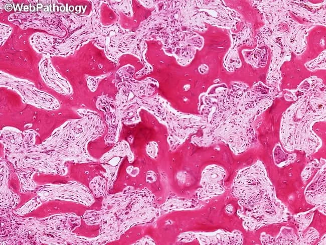 Paget disease of bone (osteitis deformans) histology showing active remodeling with mixed osteolytic and osteoblastic phases. The specimen is a decalcified long-bone or cancellous bone biopsy prepared for light microscopy and stained with hematoxylin and eosin. At higher magnification, osteoclasts are evident within resorption bays and are juxtaposed by prominent osteoblasts lining the bay openings, reflecting abrupt cycles of bone resorption followed by exuberant new bone formation. The resorption bays are irregular and often bordered by new lamellar bone with a mosaic or jigsaw-puzzle appearance. In this sample the invasive phase has progressed to fibrous and fibrovascular marrow replacement, with diminished hematopoietic elements and expanded stroma. The osteoid production is variable, and thickened trabeculae may fuse, producing coarse, sclerotic areas alongside lytic pockets. Clinically, these histologic patterns correlate with high bone turnover and disorganized remodeling that underlie the deformities and pain seen in Paget disease. The mosaicization of bone and the presence of eroded marrow spaces help distinguish Paget from metabolic or neoplastic processes, such as fibrous dysplasia or osteoblastic metastasis. Overall, the image demonstrates hallmark characteristics of active Paget remodeling and provides diagnostic confirmation in the appropriate clinical context.