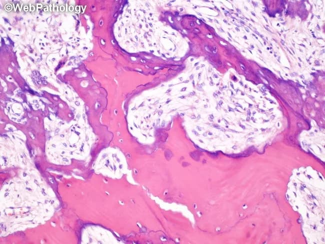 Imaging modality: light microscopy on hematoxylin and eosin stained bone biopsy section. The specimen shows features typical of Paget disease of bone (osteitis deformans) with mixed osteolytic and osteoblastic remodeling. Histology reveals osteoclast-mediated resorption cavities in the lytic phase, later filled by patches of newly formed woven bone. A mosaic pattern is evident, where woven trabeculae are separated from established lamellar bone by numerous irregular blue cement lines. The woven bone is relatively disorganized, more cellular, and accompanied by pronounced osteoblastic activity and increased osteoid deposition. The surrounding lamellar bone is thickened and sclerotic, with irregular trabecular geometry and augmented vascularity in the marrow spaces. Overall turnover is accelerated, with coexisting resorptive and formative processes. Clinically, these findings correlate with bone enlargement, deformity, warmth, and potential fragility fractures. Diagnostic significance is high for PDB when a mosaic cement line pattern is observed in the appropriate clinical setting. Differential considerations include fibrous dysplasia, osteosarcoma, osteomyelitis, and metastatic bone disease displaying mixed lytic-sclerotic changes. This histologic pattern supports diagnosis and informs management, including bisphosphonate therapy and skeletal distribution assessment in advanced disease. Correlation with radiographic findings and serum alkaline phosphatase enhances clinical decision making and surveillance during bisphosphonate courses for skeletal health.