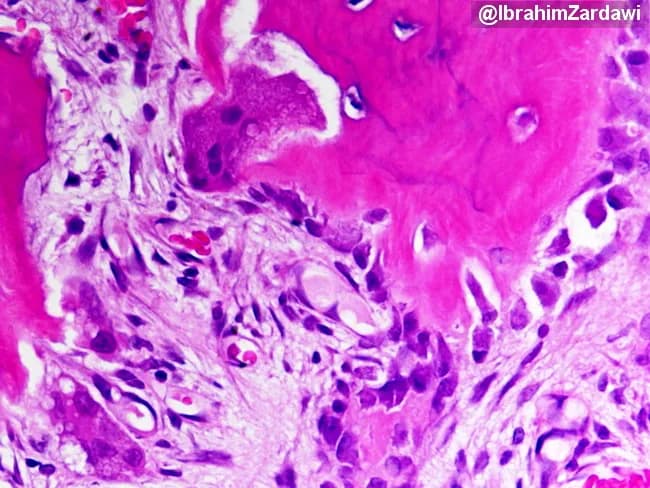 Imaging modality: Light microscopy of hematoxylin and eosin (H&E)–stained bone tissue section. Primary subject: Paget disease of bone (osteitis deformans) in a mixed osteolytic and osteoblastic phase, demonstrated by plate-like trabeculae with exuberant remodeling. Specimen: bone biopsy/surgical bone specimen. Perspective: histologic section examined under finite magnification; features documented on a transverse/longitudinal plane of trabecular bone. Visual description: broad, thickened, disorganized lamellar bone forming plate-like trabeculae; mosaic pattern of lamellar bone; cement lines appearing as irregular blue/gray intertrabecular bands; active osteoblasts line bone formation surfaces; multinucleated osteoclasts erode adjacent bone; increased vascularity and fibrous tissue may be present at the marrow interface. Pathology: accelerated bone turnover with concurrent osteolysis and osteogenesis; signs of high-output remodeling; regions of sclerosis interspersed with radiolucent zones. Diagnostic significance: the mosaic lamellar bone with cement lines is characteristic of Paget disease and helps distinguish it from osteomyelitis, fibrous dysplasia, or metastasis; correlation with clinical markers like alkaline phosphatase and imaging findings strengthens diagnosis. Potential clinical applications: confirm suspected Paget disease, guide bisphosphonate therapy, monitor treatment response, educate trainees on osteoclast–osteoblast coupling, and differentiate high-turnover bone disorders in musculoskeletal pathology. This histology correlates with radiographs showing mixed lytic and sclerotic lesions and is essential for confirming disease activity and guiding therapy response monitoring.
