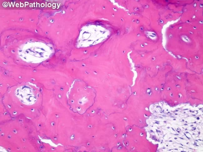 Light microscopy of an H&E stained bone biopsy reveals features characteristic of late-stage Paget disease of bone. The architecture shows thick, irregular plate-like trabeculae arranged in a mosaic or jigsaw pattern and interposed by abundant fibrous vascular tissue, reflecting extensive remodeling. Cement lines are basophilic and conspicuous, delimiting woven and lamellar bone segments and producing a dark, zigzag border between remodeling units. The marrow space is variably replaced by fibrous connective tissue and new vasculature, with relative paucity of normal hematopoietic elements. Osteoid and mineralized bone are variably deposited; osteoblastic and osteoclastic activity may be reduced in the quiescent late phase, yet turnover remains high overall relative to normal bone. The lesion exhibits a mix of eosinophilic osteoid and pink mature bone, with widening of trabecular plates and cortical thickening in surrounding regions. These features explain radiographic findings such as bone expansion, thickened cortex, and coarse trabeculae seen in Paget disease. Clinically, the image is most consistent with a long-standing, deforming process in an elderly patient and supports diagnostic conclusions in combination with serum markers of bone turnover and imaging studies. Differential considerations include fibrous dysplasia and osteosarcoma with pagetoid remodeling, but the presence of classic cement lines favors Paget disease.