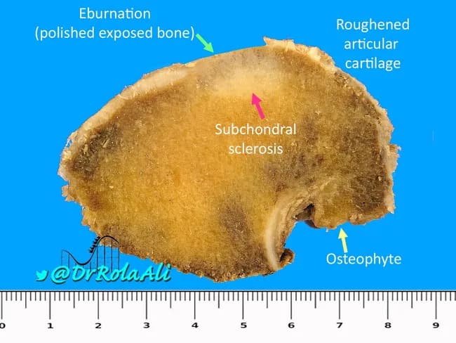 Imaging modality: Gross pathology photograph of a dissected femoral head demonstrating advanced degenerative joint disease consistent with osteoarthrosis. Specimen is the proximal femur with preserved cartilage surfaces (articular cartilage) inconsistent across regions; the dominant features include deformed, flattened joint surfaces and loss of articular cartilage bilaterally, exposing underlying subchondral bone. Subchondral sclerosis is evident as density increase beneath the cartilage, and full-thickness cartilage loss results in bone-on-bone contact at several points. Repeated articulation produces eburnation: polished, ivory-like exposed bone on opposing surfaces. Peripherally, marginal osteophytes project from the joint margin and localize along articular surfaces; these osteophytes may be covered by variable hyaline or fibrocartilage. The specimen shows deformity of the femoral head with contour irregularities and potential impingement of articular surfaces; roughened cartilage is present on exposed surfaces. The scale ruler at the base provides gross dimensions. Clinically, these findings correlate with chronic hip pain, reduced range of motion, and radiographic features of osteoarthritis such as joint space narrowing and osteophyte formation. This image is valuable for teaching gross pathology, orthopedic and rheumatology education, and cross-disciplinary differential diagnosis discussions, including osteoarthritis, secondary OA from prior trauma, and osteonecrosis with secondary degenerative changes.
