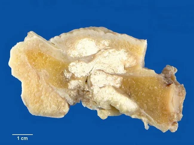 Imaging modality and technique: Gross pathology photograph of a dissected hand/phalangeal segment. The specimen shows chalky white tophi deposits (monosodium urate crystals) within the distal interphalangeal joint region and surrounding soft tissues, with visible superficial chronic inflammatory changes. The material appears friable and is characteristic of urate crystal aggregation within periarticular tissues, tendons, ligaments, and skin. The DIP joint surfaces show cartilage erosion and juxta-articular bone irregularity due to chronic inflammatory destruction. The tophi are large, with fibrous encapsulation and overlying skin thickening; in advanced disease tophi may ulcerate the overlying epidermis, discharging chalky material. The image demonstrates joint involvement commonly seen in chronic gout, though large tophaceous specimens are less common today due to modern therapy. Associated findings include synovial thickening and chronic fibrosis leading to restricted motion. The clinical history notes gouty arthritis of the great toe; the same monosodium urate deposition process may involve other joints, including fingers near the hand. This image serves educational and diagnostic documentation purposes to illustrate features of chronic tophaceous gout, including periarticular soft tissue tophi, articular cartilage erosion, juxta-articular bone destruction, and potential skin involvement. It is useful for pathology teaching, radiology correlation, and differential diagnosis discussions of gout vs CPPD.