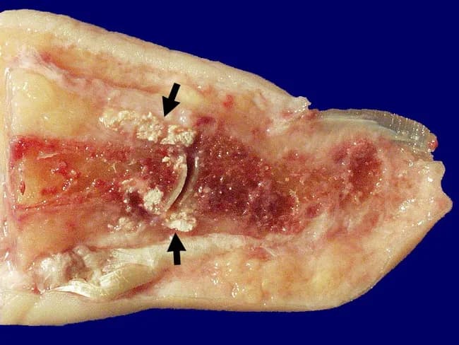 Gross pathology photograph of a toe joint showing chronic tophaceous gout with monosodium urate crystal deposition. Modality/technique: gross specimen imaging; cross‑sectional cut through the proximal interphalangeal joint (big toe) displaying soft tissue and juxta-articular bone. Anatomic site: digital toe, foot, musculoskeletal system; tissue components include tophus-contaminated soft tissues, articular cartilage and adjacent bone. Visual features: chalky, opaque white to pale yellow crystalline material adherent to articular surfaces and embedded within periarticular soft tissues; irregular joint surface erosion with subchondral bone destruction; thickened synovium with chronic inflammatory changes and fibrosis; superficial white crystalline deposits extend into surrounding ligaments and tendons; occasionally ulceration of overlying skin may be seen in advanced disease. Pathology: tophi composed of monosodium urate crystals with granulomatous inflammatory response, fibrocollagenous scar, and secondary degenerative changes; articular cartilage loss and joint-space narrowing. Clinical significance: hallmark of chronic gout and tophaceous arthritis; indicates long‑standing hyperuricemia and failed urate control; explains reduced range of motion due to fibrosis and ankylosis; aids differential diagnosis versus pseudogout, rheumatoid arthritis, osteoarthritis, and infection. Clinical/educational use: gross-pathology reference for medical education, radiologic-pathologic correlation, and therapeutic planning, including urate‑lowering treatment and tophus management. Correlates with serum urate levels, imaging findings, and clinical staging. important for prognosis.