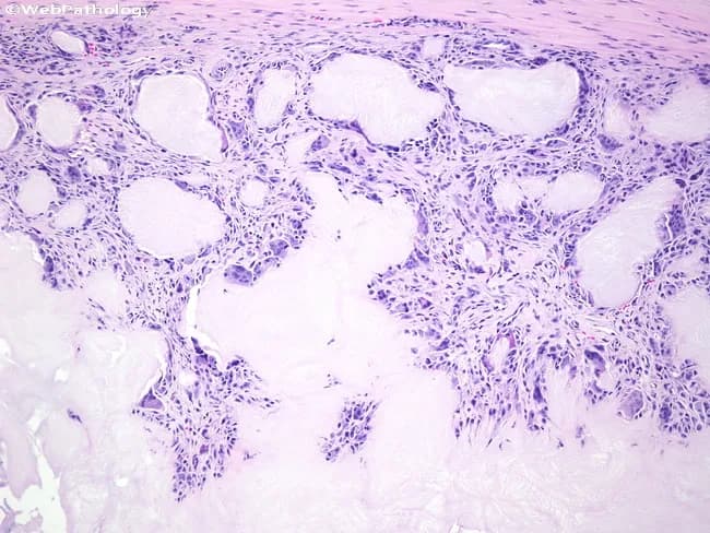 Light microscopy of a soft-tissue biopsy surrounding a gouty tophus shows extensive chalky, eosinophilic to basophilic amorphous deposits with adjacent granulomatous inflammation. Monosodium urate crystals are deposited within the periarticular soft tissue and synovium, appearing as refractile needle-shaped material that often dissolves during routine processing, leaving voids. The tophus is surrounded by a dense inflammatory capsule composed of macrophages, histiocytes, and numerous foreign body giant cells actively attempting to phagocytose crystalline material. Fibroblasts and scant lymphocytes form a fibrous stroma, with variable vascular proliferation. The gross histology may mimic a tumor or infection, but localization near joints and the characteristic granulomatous reaction supports chronic tophaceous gout. Polarized light examination would demonstrate negative birefringent crystals consistent with monosodium urate. Clinically, this pattern confirms chronic hyperuricemia with urate overproduction or reduced excretion and correlates with long-standing gout. The diagnostic significance lies in distinguishing inflammatory tophaceous gout from rheumatoid nodules, infectious arthritis, or soft-tissue neoplasms. Potential clinical use cases include confirming gout in patients with hyperuricemia, evaluating painful soft-tissue swellings around joints, and guiding urate-lowering therapy or surgical planning. This image emphasizes the pathognomonic granulomatous response to urate crystals and its impact on joint function. Correlation with serum uric acid improves diagnostic accuracy.