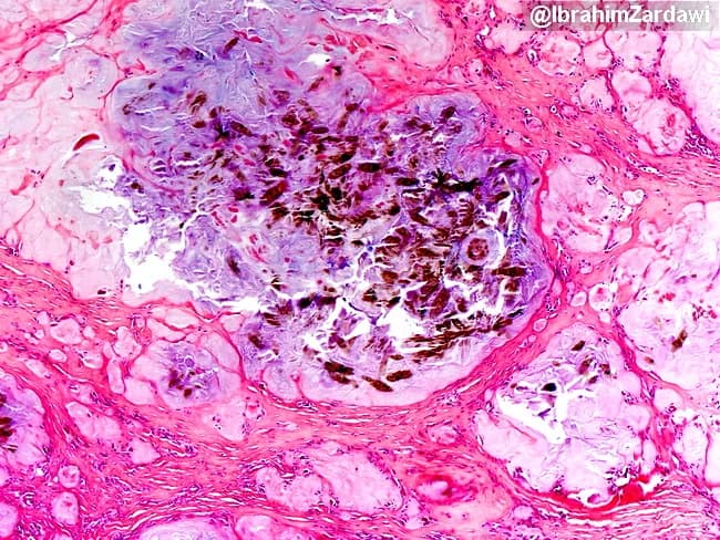 Imaging modality: Light microscopy of a hematoxylin and eosin (H&E) stained paraffin-embedded tissue section. Primary subject: Tissue with monosodium urate (MSU) crystal deposition consistent with gouty tophus formation. Specimen: Soft tissue biopsy with periarticular involvement; center shows brownish crystalline clusters representing surviving MSU crystals, while the surrounding tissue exhibits amorphous pink to amphophilic deposits after processing. Visual features: Focal granulomatous inflammatory milieu surrounds needle-shaped crystals that are dark brown in this preparation; crystals may appear refractile and needle-like within the central cluster. In paraffin-embedded material, MSU crystals are water-soluble and commonly dissolve during aqueous processing, leaving behind eosinophilic amorphous residues; however, at very high tissue concentrations, crystals may persist, as observed in the image center. Diagnostic significance: Histologic demonstration of urate deposition confirms local gout involvement and supports differentiation from other crystal arthropathies; persistence of crystals after processing indicates high tissue urate burden and can reflect delayed or inefficient processing. Clinical correlation: Correlate with patient history of hyperuricemia or gout, joint pain, tophi formation, and responsiveness to urate-lowering therapy. Potential use cases: educational illustration of gout pathology, research on crystal-induced inflammation, and aiding differential diagnosis in soft-tissue lesions.