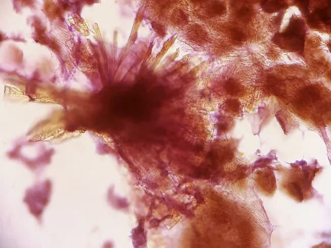 This fine-needle aspiration cytology image demonstrates a gouty tophus in soft tissue of the distal extremity (ankle/toes) from a 55-year-old female. FNA performed with a 23-gauge needle yielded material that, on light microscopy, comprises amorphous granular debris with dense aggregates of slender, needle-shaped crystals possessing pointed tips. The crystals are characteristic of monosodium urate and the appearance aligns with gouty tophus formation. The surrounding background may include inflammatory cells, macrophages and necrotic debris; the crystals may appear birefringent under polarized light (negatively birefringent under compensated polarized microscopy). These findings confirm the cytologic diagnosis of gout and help distinguish a potentially infiltrative soft-tissue lesion from infectious or neoplastic processes. Clinically, this supports uric acid–lowering therapy and appropriate anti-inflammatory management, with surgical excision considered for symptomatic tophi. In differential considerations, calcium pyrophosphate deposition (pseudogout) can mimic crystals but typically shows rhomboid crystals; infectious etiologies (tenosynovitis, septic arthritis) and soft tissue tumors must be excluded. This image is valuable for pathology education, differential diagnosis training, and clinical decision-making in patients with chronic gout presenting with foot and ankle nodules. This case exemplifies cytology's role in confirming crystal-induced pathology and guiding targeted therapy, reducing unnecessary procedures and improving diagnostic confidence in soft-tissue gout diagnosis.