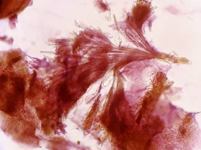 Fine-needle aspiration cytology (FNAC) of a soft tissue lesion around the ankle/toes was performed using a 23-gauge needle. The aspirate shows amorphous granular material with cohesive aggregates of needle-shaped crystals possessing pointed tips, consistent with monosodium urate crystals in a gouty tophus. The background contains inflammatory cells and multinucleated giant cells, reflecting a granulomatous reaction to crystal deposition. Stained cytology commonly employs Papanicolaou or Romanowsky stains to highlight needle crystals, which appear slender with sharp ends and may form rosettes or fragile bundles. These features distinguish tophi from other crystal deposits and inflammatory masses. Clinically, this cytologic profile supports a diagnosis of chronic tophaceous gout involving soft tissues around the ankle and digits, particularly in patients with hyperuricemia or prior gout attacks. Differential considerations include calcium pyrophosphate dihydrate (CPPD) crystals (rhomboid shapes), cholesterol crystals, or infectious/inflammatory nodules; however, the characteristic needle-shaped, negatively birefringent urate crystals are highly specific. Diagnostic significance lies in definitive cytologic demonstration of monosodium urate within inflammatory stroma, guiding urate-lowering therapy and anti-inflammatory management. Correlate with serum uric acid, renal function, and imaging studies for comprehensive disease assessment and therapeutic planning; case contributed by Dr. Dhiraj Nikumbh. This case highlights diagnostic utility for aspiration cytology and treatment.