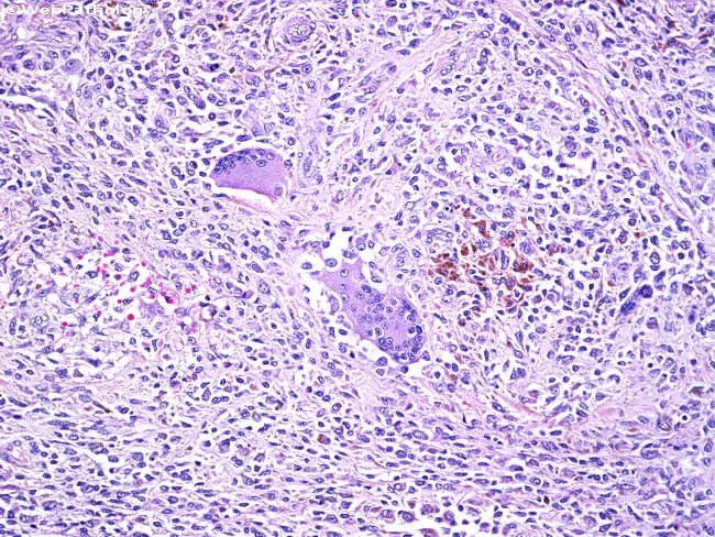 This is a light microscopy image of a tissue biopsy stained with hematoxylin and eosin (H&E). The slide shows granulomatous inflammation with multinucleated giant cells and scattered hemosiderin-laden macrophages embedded in a dense inflammatory background. Epithelioid histiocytes predominate, forming nodular aggregates with elongated nuclei, abundant cytoplasm, and indistinct cell borders. Multinucleated giant cells are evident within the granulomas, sometimes with a peripheric arrangement suggestive of Langhans-type morphology. Intermixed small lymphocytes and plasma cells contribute to the chronic inflammatory milieu. Brown to golden-brown hemosiderin pigment within macrophages is conspicuous and suggests prior hemorrhage or vascular congestion; occasional clusters of iron-laden macrophages are dispersed in the interstitium. Mild edema and vascular congestion may be present; necrosis is not a prominent feature in this field. The tissue architecture reflects organized granulomatous reaction rather than acute suppurative inflammation. No overt microbial organisms are visible at this magnification; however, special stains or molecular tests are required to identify potential infectious etiologies. Clinically, these findings raise differential diagnoses including mycobacterial and fungal infections, sarcoidosis, foreign body granulomatous reaction, or hemorrhagic granulomatous response. This image is valuable for diagnostic pathology review, education on granulomatous histology, and research into macrophage activation and iron handling in chronic inflammation process.