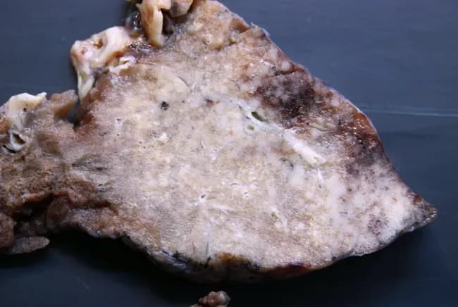 Gross pathology photograph of a lung tissue resection specimen illustrating an invasive mucinous adenocarcinoma with a prominent lepidic component. The tumor demonstrates ill-defined, infiltrative borders at the periphery, with a mucin-rich, gelatinous appearance and patchy grey-white parenchymal involvement. The gross pattern resembles infectious processes such as bronchopneumonia or even tuberculosis, posing a diagnostic pitfall on radiologic and clinical assessment prior to histology. The lesion is located in the peripheral lung (subpleural involvement), with predominant lepidic spread along alveolar septa contributing to the indistinct margins. On macroscopic inspection there is absence of discrete, well-circumscribed nodules; instead, broad-based infiltration disrupts normal parenchyma. Corresponding microscopic diagnosis would require correlation with histopathology to confirm adenocarcinoma with mucin production and lepidic growth, often associated with mucin pools and gland-forming cells. Clinically, recognizing this entity is essential for accurate staging (T modifiers reflecting lepidic invasion) and for planning surgical resection and adjuvant therapy. This image supports education on differential diagnosis for radiologic consolidation, emphasizes the mimicry of infection, and serves as a visual reference for pathologists and surgeons assessing suspicious lung lesions. The gross features underscore the need for tissue confirmation and multidisciplinary discussion to optimize prognosis and therapeutic strategy, correlating radiology, pathology, and clinical data together.