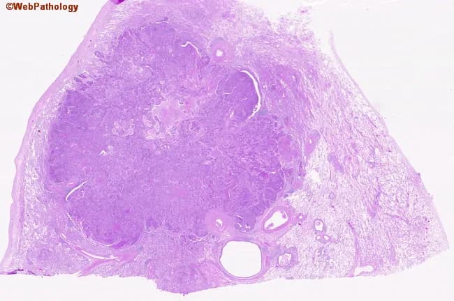 Digital whole-slide histopathology image of a peripherally located lung squamous cell carcinoma captured on a hematoxylin and eosin stained section. The specimen represents peripheral parenchyma with a bronchogenic carcinoma infiltrating the lung periphery. On low- and high-power inspection, nests and irregular clusters of polygonal tumor cells extend from the capsule into adjacent stroma. Tumor cells exhibit eosinophilic cytoplasm, distinct cell borders, and prominent nuclei with coarse chromatin; intercellular bridges may be visible, and occasional keratinization features can be present in well-differentiated foci. The surrounding lung parenchyma shows desmoplastic stromal response and inflammatory infiltrate. The lesion demonstrates peripheral localization, an infiltrative growth pattern, and disruption of normal alveolar architecture. The image supports a histopathologic diagnosis of squamous cell carcinoma due to squamous differentiation, keratinization in places, and intercellular keratin bridges; such morphology is typical in smokers with bronchogenic carcinoma. Clinically, this histology correlates with a smoking history and indicates a solid, non-small cell lung cancer variant with squamous lineage. This image would be valuable for educational purposes, pathology review, differential diagnosis with adenocarcinoma or large cell carcinoma, and in teaching about tumor-stroma interactions in peripheral lung cancers. Correlation with clinical history enhances interpretive accuracy and guides multidisciplinary care in treatment planning.