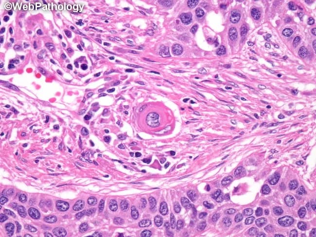 This is a brightfield histopathology image of an invasive, well-differentiated squamous cell carcinoma in epidermal/mucosal squamous epithelium. The H&E stained section demonstrates malignant squamous cells in nests and cords penetrating the dermis with desmoplastic stromal reaction. Characteristic features include abundant eosinophilic cytoplasm, keratinization in the form of keratin pearls, and pronounced intercellular bridges between adjacent tumor cells. Some tumor clusters show concentric keratinization around a central keratin pearl; intracellular mucin may be present in scattered malignant cells, though not a dominant feature in well-differentiated tumors. The cells exhibit minimal pleomorphism and relatively preserved nuclear-to-cytoplasmic ratio compared with poorly differentiated SCC. The presence of keratin pearls and intercellular bridges supports squamous differentiation and a diagnosis of squamous cell carcinoma. In non-keratinizing or poorly differentiated variants, immunohistochemistry for squamous markers (p40, p63, CK5/6) and absence of TTF-1 would aid differential; mucin positivity would favor adenosquamous or mucinous differentiation. Clinically, this finding is relevant for tumor staging and treatment planning, including surgical excision with clear margins and consideration of adjuvant therapy depending on invasion depth and perineural or lymphovascular invasion. This image is suitable for educational reference and image-based pathology teaching, and for validating histologic criteria of keratinizing SCC.