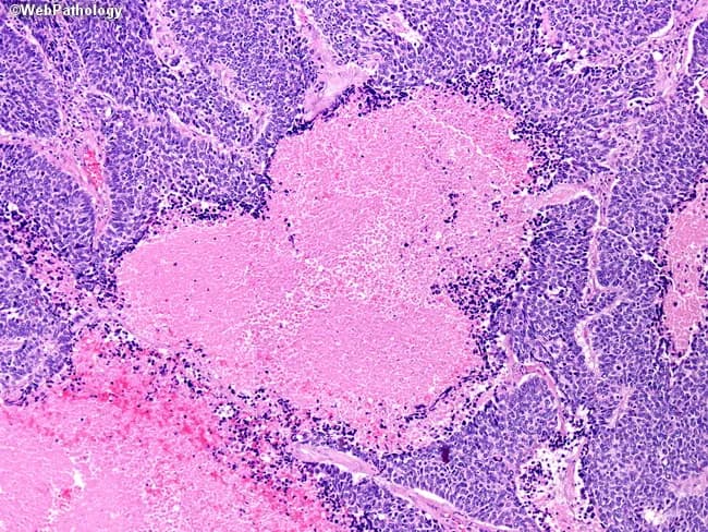 This histopathology image depicts a hematoxylin and eosin-stained lung tissue section showing features characteristic of pulmonary small cell carcinoma with geographic necrosis. The neoplasm is composed of densely packed small round to oval blue cells with scant cytoplasm, ill-defined cell borders, and finely granular, stippled chromatin. Nuclear molding and high mitotic activity are evident in the viable tumor islands, consistent with a high-grade neuroendocrine carcinoma. Within the tumor mass, large pale pink zones of geographic necrosis interrupt cellularity and are surrounded by a rim of residual malignant cells and inflammatory infiltrate. The surrounding non-neoplastic lung parenchyma shows preserved air spaces and alveolar septa without clear organization, highlighting the destructive nature of this tumor. The morphological pattern—sheets and nests of small cells with scant cytoplasm and necrotic foci—supports the diagnosis of small cell lung carcinoma. Clinically, this tumor is aggressive, often centrally located, and associated with paraneoplastic syndromes; histology guides systemic chemotherapy and radiotherapy planning. This image serves as an educational reference for recognizing small cell carcinoma histology, necrotic geography, and the characteristic high-grade appearance in pulmonary tissue. Recognizing this pattern aids differential diagnosis and informs oncologic management. Immunohistochemical confirmation may be pursued if needed.