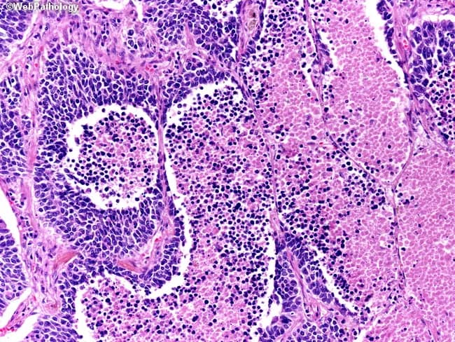 This slide depicts a high-fidelity hematoxylin and eosin stained section of lung tissue analyzed by light microscopy at approximately 400x magnification. The lesion resides within the pulmonary parenchyma with features characteristic of small cell lung carcinoma (SCLC), a high-grade neuroendocrine tumor. Tumor cells form cohesive nests and sheets separated by delicate fibrovascular stroma. Cells are small to medium in size with scant cytoplasm, round to oval nuclei, and finely granular ('salt-and-pepper') chromatin; nuclear molding and frequent mitotic figures are evident. Geographic necrosis is present, producing irregular foci of eosinophilic debris and ghost-like tumor islands, a hallmark of aggressive neoplasia. Background lung tissue shows residual non-neoplastic alveolar parenchyma with inflammatory infiltrates. The overall pattern is consistent with a central, rapidly proliferating tumor commonly associated with early metastasis. Immunophenotypic confirmation (not shown) would typically reveal neuroendocrine markers such as synaptophysin, chromogranin A, and CD56. Clinically, this histology aligns with a diagnosis of primary small cell lung carcinoma and has implications for oncologic management, favoring systemic platinum-based chemotherapy with adjunctive radiotherapy. The image is valuable for educational purposes, differential diagnosis training, and correlation with radiologic findings in lung cancer workups.