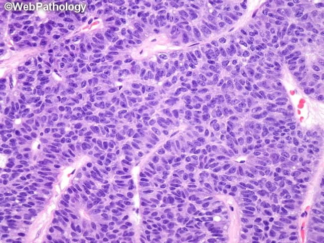 This histopathology image depicts a pulmonary neuroendocrine tumor consistent with carcinoid. The specimen is a lung tissue biopsy prepared as formalin-fixed paraffin-embedded sections, stained with hematoxylin and eosin. Under high magnification, there is a uniform population of small to medium-sized cells arranged in nests and trabeculae (organoid nesting) with rosette-like features and delicate vascular cores. The tumor cells show round to oval nuclei with finely dispersed salt-and-pepper chromatin, pale nucleoli, and scant cytoplasm; mitotic activity is low in typical carcinoids, with limited necrosis. The architectural pattern demonstrates bland cytology with minimal pleomorphism and a relatively low Ki-67 index (if tested), supporting a low-grade neuroendocrine neoplasm. Clinically, such lesions arise in the lung and require differentiation from atypical carcinoids and high-grade neuroendocrine carcinomas (small cell carcinoma or large cell neuroendocrine carcinoma) due to differences in prognosis and treatment approach. Imaging features on histology correlate with indolent behavior, potential for surgical resection, and regional lymph node assessment. Immunohistochemical profiling (not shown) typically reveals neuroendocrine markers such as chromogranin A, synaptophysin, and CD56, with MEN1 involvement noted in a subset of cases. The image illustrates classic histomorphology that pathologists use to classify pulmonary carcinoids and guide clinical management.