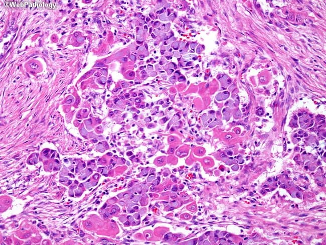 This histopathology slide depicts lung tumor tissue examined by light microscopy following hematoxylin and eosin staining. The specimen is derived from pulmonary parenchyma in a region containing tumor cells. The architecture shows a hybrid neoplasm composed of mucin-producing cells arranged in gland-like clusters and adenomatoid glands intermingled with nests of squamous cells, characterized by dense eosinophilic cytoplasm and rounded to polygonal nuclei. Mucinous cells exhibit bluish cytoplasm and intracytoplasmic mucin; squamous cells display keratinization features and abundant eosinophilic cytoplasm; together they confirm a combined histology with two distinct subtypes. The background stroma contains desmoplastic reaction and inflammatory infiltrate in places. This pattern is typical of adenosquamous carcinoma of the lung, observed in roughly 10% of lung cancers, where prognosis and therapeutic decisions hinge on the more aggressive component. Clinically, such tumors portend a poorer prognosis than pure adenocarcinoma or pure squamous cell carcinoma and may influence choices between surgical resection and systemic therapy. Immunophenotypic profiling (TTF-1 and Napsin A positivity for glandular components; p40/p63 positivity for squamous components) can assist subtyping. Recognize that combined histology carries implications for staging, prognosis, and potential targeted regimens; differential considerations include pure adenocarcinoma with mucin production, pure squamous cell carcinoma, or small cell variants.