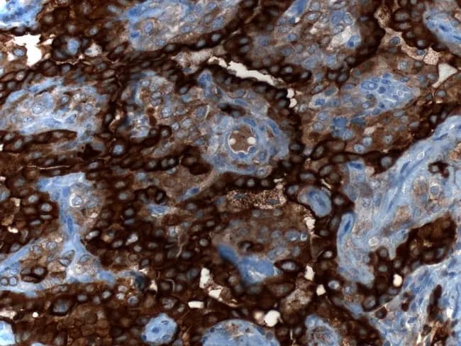 Immunohistochemistry image of lung tissue demonstrating epithelial membrane antigen (EMA) immunoreactivity in a sclerosing pneumocytoma. The tissue section is stained with EMA (brown DAB chromogen) and counterstained with hematoxylin (blue), visualized under bright-field light microscopy. The specimen is a pulmonary lesion composed of two characteristic cell populations: surface epithelial–like cuboidal cells forming papillary structures, and underlying round stromal cells embedded in fibrous or sclerotic stroma. In this image EMA expression is evident on the membranes of both surface and stromal cells, producing a continuous brown membranous outline along cell borders. The combination of EMA positivity in both compartments supports the neoplastic nature of the lesion and aligns with the dual-cell phenotype seen in sclerosing pneumocytoma, formerly called sclerosing hemangioma. The notable histologic context includes papillary folds, sclerosis, and occasional hemosiderin-laden macrophages, but without overt cytologic atypia or high mitotic activity. Clinically, EMA positivity helps distinguish this entity from adenocarcinoma and other primary lung neoplasms, particularly in the setting of ambiguous morphology. EMA positivity highlights diagnostic utility of IHC for differential diagnosis, emphasizing surface and stromal immunophenotype, and supports the benign behavior and favorable prognosis after surgical excision. Pathorama.ch provided caption and licensing.