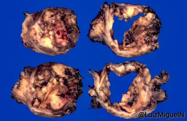Gross pathology photograph of an angiomatoid fibrous histiocytoma showing a soft tissue tumor with solid nodules and hemorrhagic cystic spaces on cross-section. The four-panel montage reveals variegated tan-brown to red tissue, with hemorrhagic cavities and degenerative areas. This macroscopic appearance aligns with AFH, a mesenchymal soft tissue neoplasm that may present with hemorrhagic, cystic, and pseudoangiomatous features. The specimen type is a resection/excisional soft tissue tumor. No histologic staining or imaging contrast was used in these gross images. Clinically, AFH is more common in children and young adults and often arises in the extremities or trunk; however, location is not specified here. Diagnosis cannot be confirmed on gross morphology alone; histopathology demonstrating nodular growth with fibrous capsule, perivascular cuffing, and immunohistochemical positivity for markers such as CD68, desmin, or EMA can support diagnosis alongside molecular tests (EWSR1-CREB1, EWSR1-ATF1). This image is valuable for education, pattern recognition, and differential diagnosis training in soft tissue tumors and pathology. The image supports radiologic-pathologic correlation by highlighting how gross features may reflect underlying histology, such as hemorrhagic cystic change and fibrous encapsulation, which guide sampling strategy, surgical planning, and diagnostic sequencing in pediatric and young-adult soft tissue oncology.