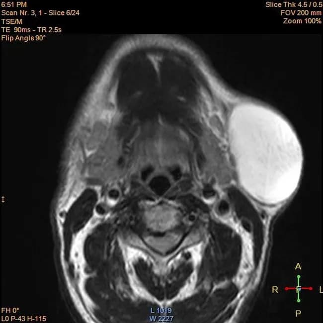 Imaging modality: Magnetic Resonance Imaging (MRI). This axial T1-weighted neck image demonstrates a well-defined oval lesion within the left submandibular soft tissues. The mass shows high signal intensity on T1 and remains bright on T2-weighted sequences, consistent with a fat-containing lesion. A thin capsule and sharp margins are evident; there is no invasion of adjacent bone or deep soft tissues. There is no edema, diffusion restriction, or surrounding inflammatory change. The radiologic appearance is classic for a lipoma, a benign adipose tumor composed of mature fat cells. The lesion is nonadherent to surrounding structures, and there is no surrounding lymphadenopathy. The clinical presentation is a painless, slowly enlarging swelling in a 60-year-old male. Differential considerations include other fat-containing lesions such as lipoblastoma in younger patients or liposarcoma in older adults, but the homogeneous high T1 signal with no suspicious septations or nodularity favors lipoma. Post-contrast imaging, if performed, would typically show minimal to no enhancement. This imaging feature set informs preoperative planning by delineating lesion size, extent, and relationship to the submandibular gland, mandible, and facial artery branches, aiding surgical approach and reducing biopsy need while histopathology remains definitive. Correlation with surgical and histopathology findings confirms benign diagnosis.