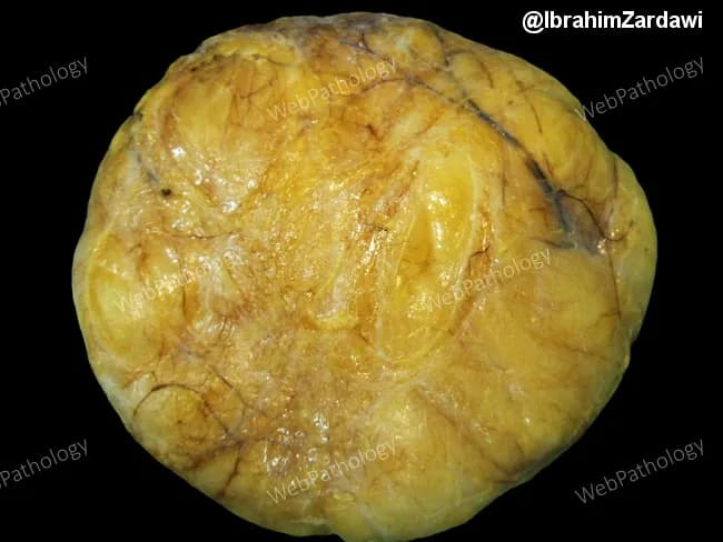 Gross pathology photograph of a superficial subcutaneous lipoma. The specimen is a soft, yellow, well-circumscribed fatty tumor surrounded by a thin fibrous capsule. Size ranges typically from less than 1 centimeter to about 5 centimeters in greatest dimension, with a median near 3 cm; deeper lipomas tend to be larger and more irregular, yet they retain a thin capsule that separates them from adjacent tissues. The surface is smooth to faintly lobulated; the cut surface is homogeneous, yellow-orange with delicate fibrous septa. The lesion is encapsulated and noninfiltrative, composed of mature adipocytes arranged in lobules. The gross appearance is characteristic of benign adipose tumors, but differentiation from liposarcoma relies on histology, especially in large, deep, or atypical lesions. This image, courtesy of Dr. Ibrahim Zardawi, illustrates classic macroscopic features used in medical education to distinguish benign lipomas from other soft tissue neoplasms. Clinically, lipomas present as soft, mobile, painless nodules in adults, with minimal inflammation. In pathology practice, this photograph supports gross specimen handling, capsule presence, adipocyte morphology, and gross differential considerations. Potential clinical applications include education, radiology-pathology correlation, gross pathology benchmarking, and informing surgical pathology reporting. This educational image supports accurate gross diagnosis and consistent documentation standards in practice.