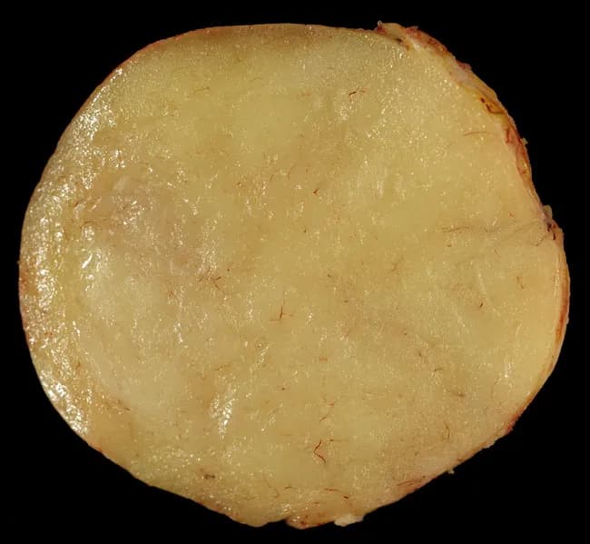Gross pathology photograph of a soft tissue lipoma, captured on a transverse or cross-sectional cut surface. Anatomy: subcutaneous adipose tissue lesion arising within superficial soft tissue; location may be head, neck, trunk, or extremities, typically in the hypodermis. Visual features: lobulated, homogeneous, greasy appearance with a pale yellow to orange color; surface is often smooth and well circumscribed, reflecting a benign adipocytic tumor with little inflammatory change. Internal architecture may appear uniformly fatty with fine fibrous septa; occasional fat necrosis or hemorrhage can create focal discoloration or nodular heterogeneity, especially in longstanding lesions. Pathology: composed of mature adipocytes arranged in lobules, with minimal cytologic atypia and a fibrous capsule in many cases; variants such as fibrolipoma or angiolipoma may show additional stromal or vascular components altering texture and color. Diagnostic significance: gross features strongly support lipoma, but definitive diagnosis requires histopathology to exclude liposarcoma or other adipocytic neoplasms; correlate with clinical growth pattern and imaging findings. Clinical relevance: benign, slow-growing, often amenable to simple excision; symptoms and depth influence management. Educational value: provides reference for gross morphology of adipose tumors, differential diagnosis of fatty soft tissue masses, and correlation with radiologic fat density on MRI/CT. Educational use in pathology teaching.