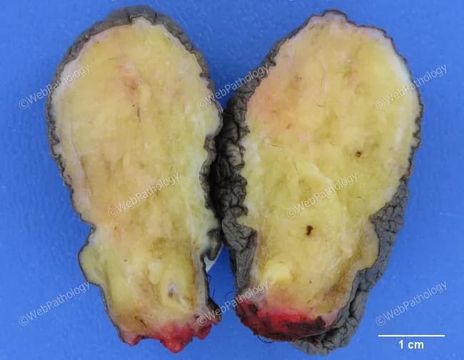 Gross pathology photograph of a fibrolipoma, a lipoma variant characterized by intimate admixture of mature adipose tissue and dense fibrous connective tissue. The image presents a subcutaneous soft tissue lesion in two symmetrical halves with a yellow-taint fatty core and delicate pink-tan fibrous bands extending through cut surface. The outer contour appears encapsulated by a translucent capsule, while the cut surface reveals lobulated adipose tissue partitioned by fibrous septa. The scale bar indicates 1 cm, showing a lesion of a few centimeters in dimension. The specimen displays a well-circumscribed, benign lipomatous tumor with fibrous stroma, consistent with fibrolipoma. Microscopically, the lesion would demonstrate mature adipocytes arranged in lobules separated by thick fibrous septa; absence of lipoblasts, cellular atypia, or necrosis; lack of significant vascular proliferation. This entity represents a benign mesenchymal tumor variant caused by fibrous connective tissue within lipoma; it can present similarly to conventional lipoma but with firmer consistency or increased firmness due to fibrous components. Clinical significance includes differentiation from liposarcoma; surgical excision is curative in typical cases, with rare recurrence. Potential clinical use cases include educational demonstrations of lipoma variants, gross pathology recognition, and differential diagnosis between benign adipocytic tumors and malignant liposarcomas in soft tissue.