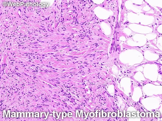 This histopathology image depicts a mammary-type myofibroblastoma of soft breast tissue, evaluated by light microscopy following formalin fixation and hematoxylin and eosin (H&E) staining. The lesion demonstrates a spindle cell-dominated stroma composed of slender, elongated myofibroblastic cells arranged in short fascicles and sweeping, interlacing patterns. Cells display bland nuclei with minimal pleomorphism and scant mitotic activity. Intervening, thick, hyalinized collagen bands create a fibrous, fibrotic background that partitions the tumor into bands and sheets. Adjacent adipose tissue is present, producing a minor adipocytic component that may be seen at the periphery, consistent with the biphasic appearance observed in some mammary-type myofibroblastomas. Immunophenotype, while not evident in H&E, classically shows CD34 positivity and absence of desmin or h-caldesmon in many cases, supporting a myofibroblastic lineage. The differential diagnosis includes dedifferentiated liposarcoma, which typically harbors MDM2/CDK4 amplification (12q13-15) and demonstrates lipogenic atypia, higher mitotic activity, and potential heterologous differentiation; mammary-type myofibroblastoma is associated with 13q/Rb family alterations and lack of aggressive features. Clinically, these tumors are benign or of low malignant potential, with excellent prognosis following local excision. Diagnostic significance centers on distinguishing from liposarcoma and other spindle cell neoplasms to guide management.