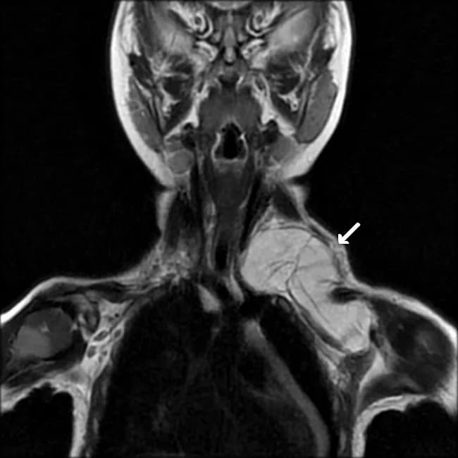 Imaging modality and technique: Magnetic Resonance Imaging (MRI) with T2-weighted coronal sequence. Clinical context: a 2-year-old female with a rapidly enlarging neck mass. Anatomic distribution: a large, well-defined lipomatous soft tissue mass encompasses both the supra- and infraclavicular neck regions. Morphology: internal septations are evident within the lesion. Signal characteristics: lesion is fatty in nature, showing high signal on T1-weighted and T2-weighted images with near-complete suppression on fat-saturated sequences, consistent with adipocytic tissue. Anatomic relations: the mass displaces adjacent soft tissues without definite invasion; margins are well circumscribed, suggesting benign behavior. Pathology and diagnosis: histologic examination after excision confirmed lipoblastoma, a pediatric adipocytic tumor displaying lobulated architecture with vacuolated adipocytes and immature lipoblasts amid a myxoid stromal background. Clinical significance: lipoblastoma should be included in the differential diagnosis of pediatric neck masses with fatty signal; MRI features—multiloculated fat-containing mass with internal septations and fat suppression behavior—help distinguish from lipoma and other lipomatous lesions. Differential considerations: lipoma, fibrolipoma, and rare pediatric liposarcoma; correlation with symptoms and growth rate is essential. Management and prognosis: complete surgical excision is standard; prognosis is favorable though recurrence can occur. Educational use: case emphasizes pediatric soft-tissue neoplasms and imaging-pathology correlation.